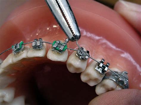 como limpiar los brackets metalicos|cómo limpiar los brackets.